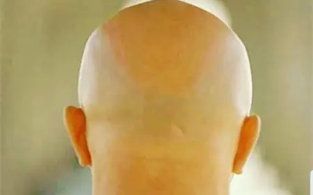 الرجال الصلع الأكثر عرضة للإصابة بفيروس كورونا