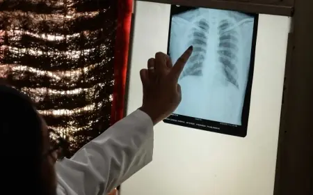 داء السل يثير قلق سكان إكنيون.. وبرلماني يطالب بتدخل عاجل