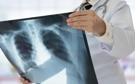 المغرب يعزز جهوده لمكافحة السل مع تركيز خاص على الحالات خارج الرئة