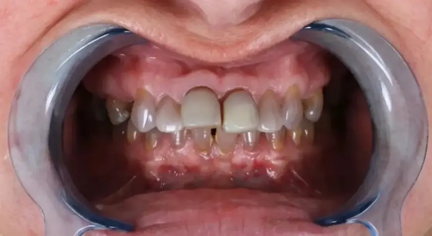 طبيبة أسنان تكشف أسباب اصفرار الأسنان وطرق استعادة لونها الطبيعي